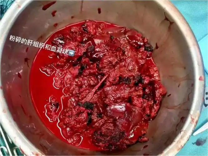 肝破裂大出血4000ml!罗湖医院紧急抢救18岁小伙-罗湖区人民医院