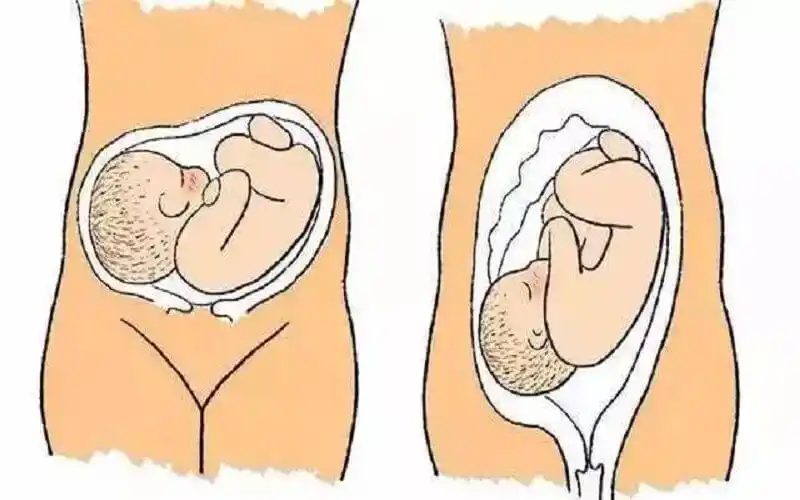 胎儿横位示意图