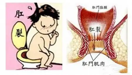 脓肿|肛瘘|肛周|直肠_网易订阅