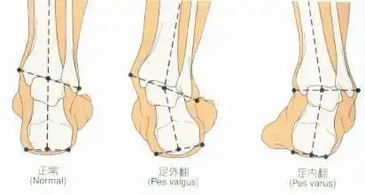 足外翻