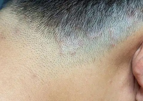 癣是什么样子的图片及皮肤癣症状-中华银屑病网