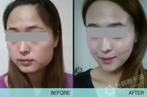 打瘦脸针后脸部凹陷是怎么回事可以恢复吗