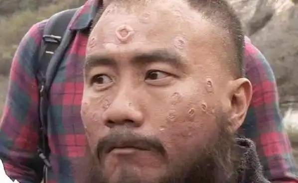 什么是苍蝇屎什么是痣,宝宝后背,肉里长进黑颗粒,直到三岁,才被抠出