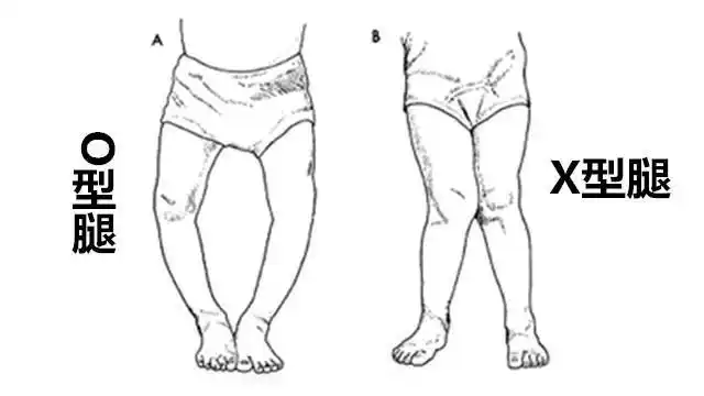 宝宝o型腿罗圈腿好尴尬,3个错误行为导致宝宝罗圈腿_腾讯新闻