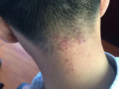颈部皮疹