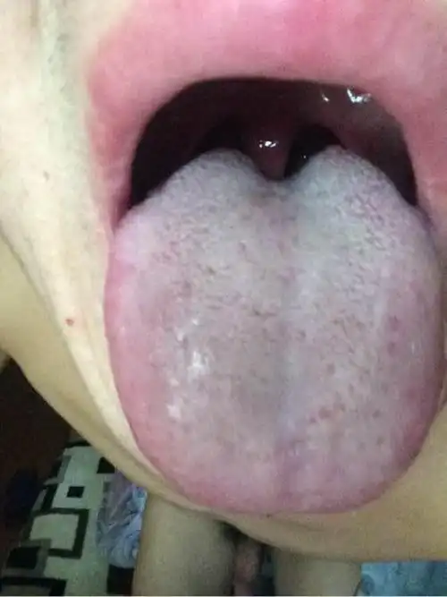 脾肾阳虚阳虚伤精虚寒湿气大的舌照