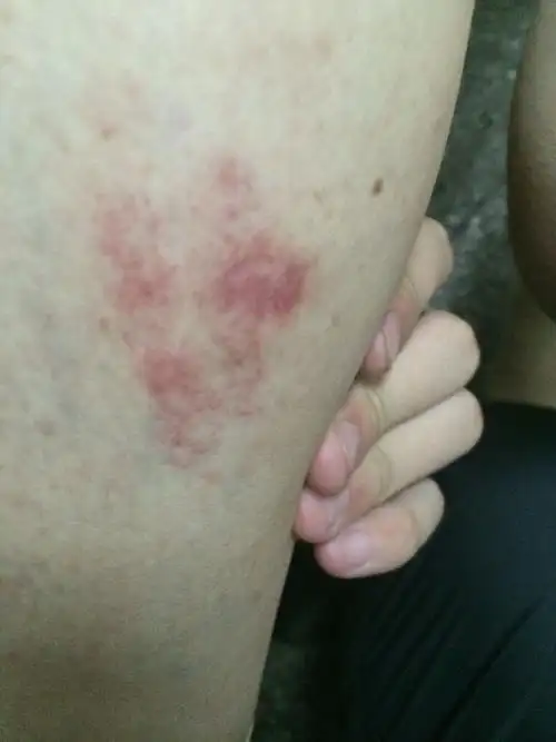 小腿上出现奇怪红斑