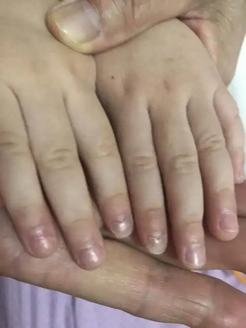 手足口病与指甲脱落 - 好大夫在线