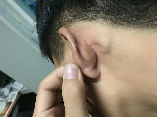 医生您好前天我耳朵后面出了个疙瘩硬硬的不疼不痒就是感觉别扭还