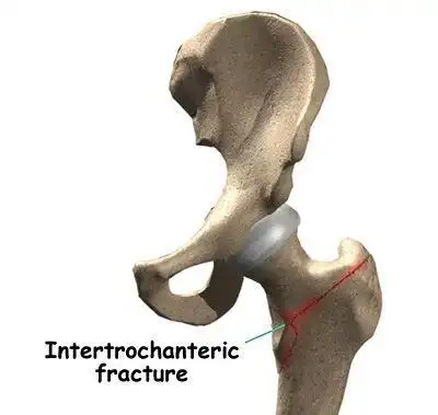 股骨粗隆间骨折