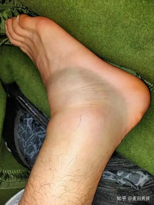 右踝关节扭伤崴脚恢复记录