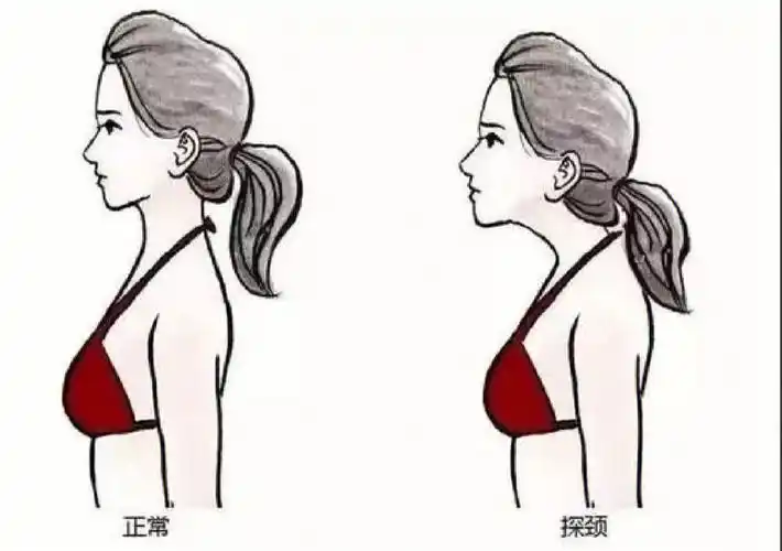 颈椎生理曲度脖子前倾如何矫正