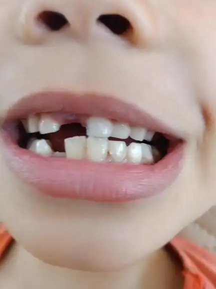 手机/通讯  展开全部 乳前牙脱落后,新长出的恒牙切端不平整呈"锯齿状