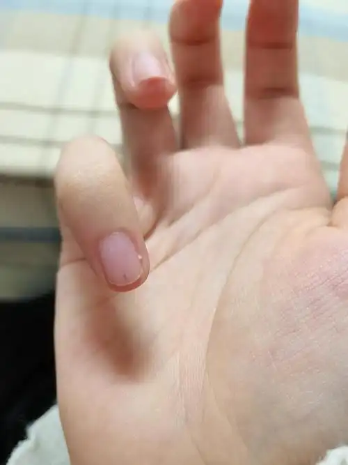 剪指甲发现小指甲里面有根黑线