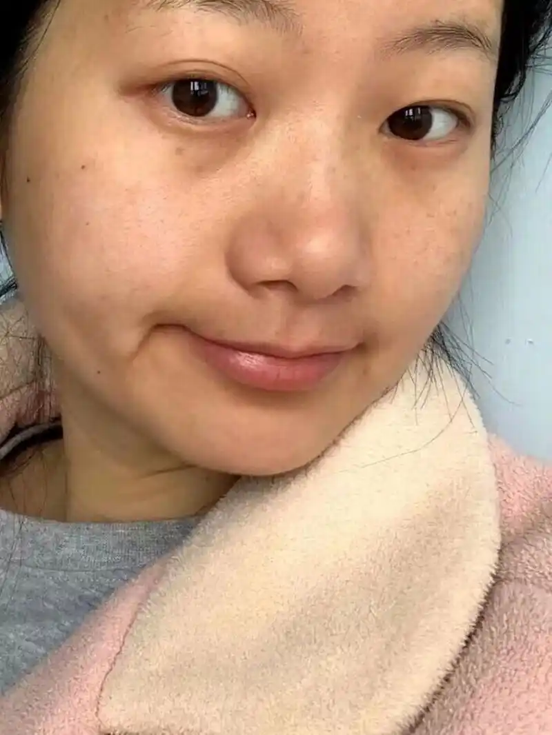 t区,嘴周围蜡黄肤色不均怎么破解啊!额头下巴,暗沉还夹杂着痘印和闭口