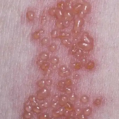 疼死了得了蛇胆疮看什么门诊好啊