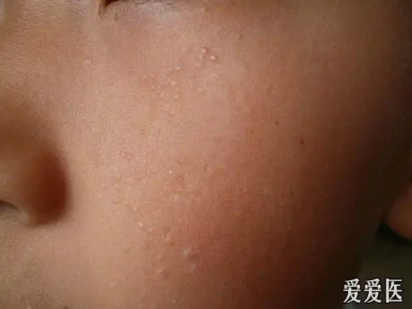 小儿面部同患两种皮肤病扁平疣粟丘疹