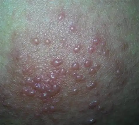 身上起了好多小红疙瘩很痒怎么回事?大人长湿疹了怎么办