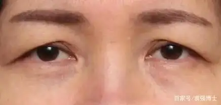 上眼皮松弛耷拉,这3种方法会有效
