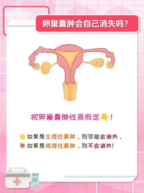 卵巢囊肿可能会自己"消失"?真相来了!