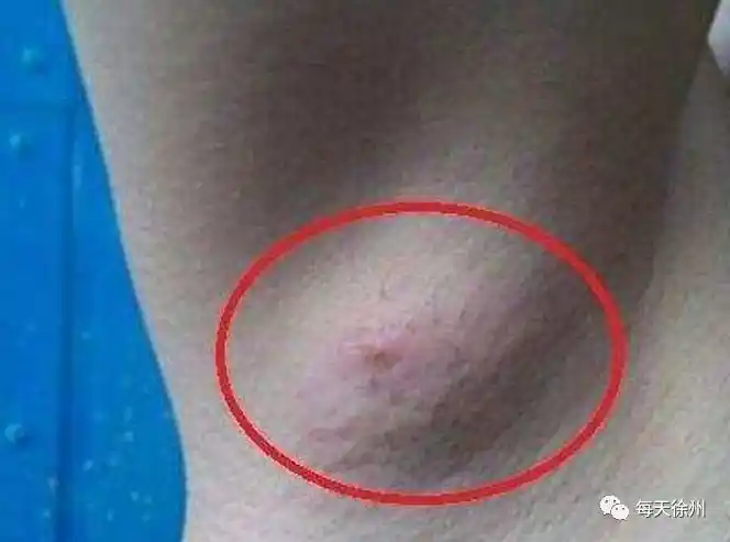 女性如果出现这五个症状, 请尽快就医, 可能患上了乳腺癌!