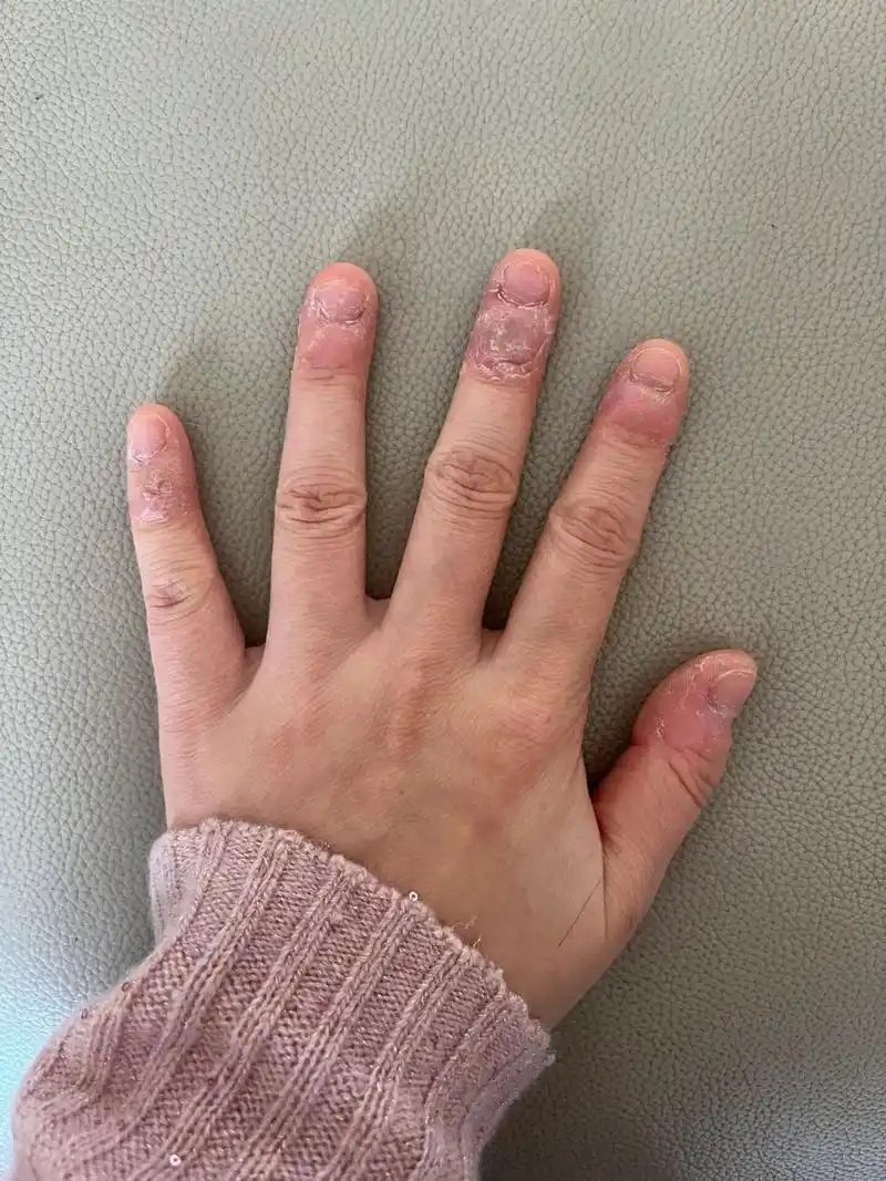 挑战全网最丑手… 从小就有抠手的习惯,一直到现在,还是很难戒掉.