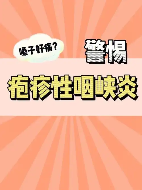 疱疹性咽峡炎是一种肠道病毒感染引起的急性传染性咽峡炎.