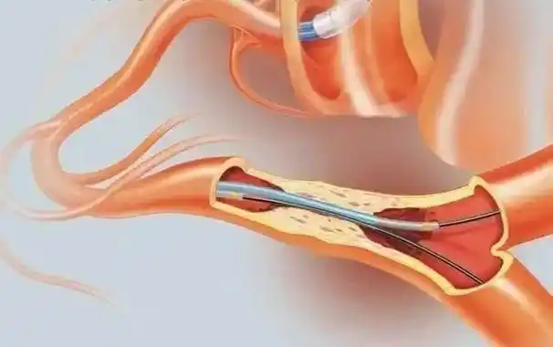 陇西县第二人民医院独立完成首例冠脉造影冠状动脉支架植入术