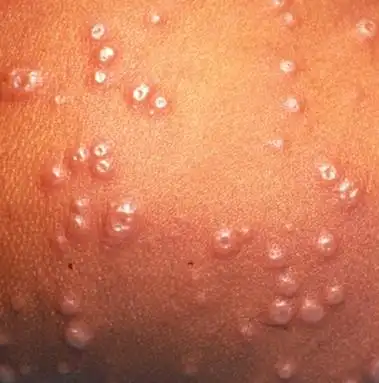 天花疱疹怎样治疗