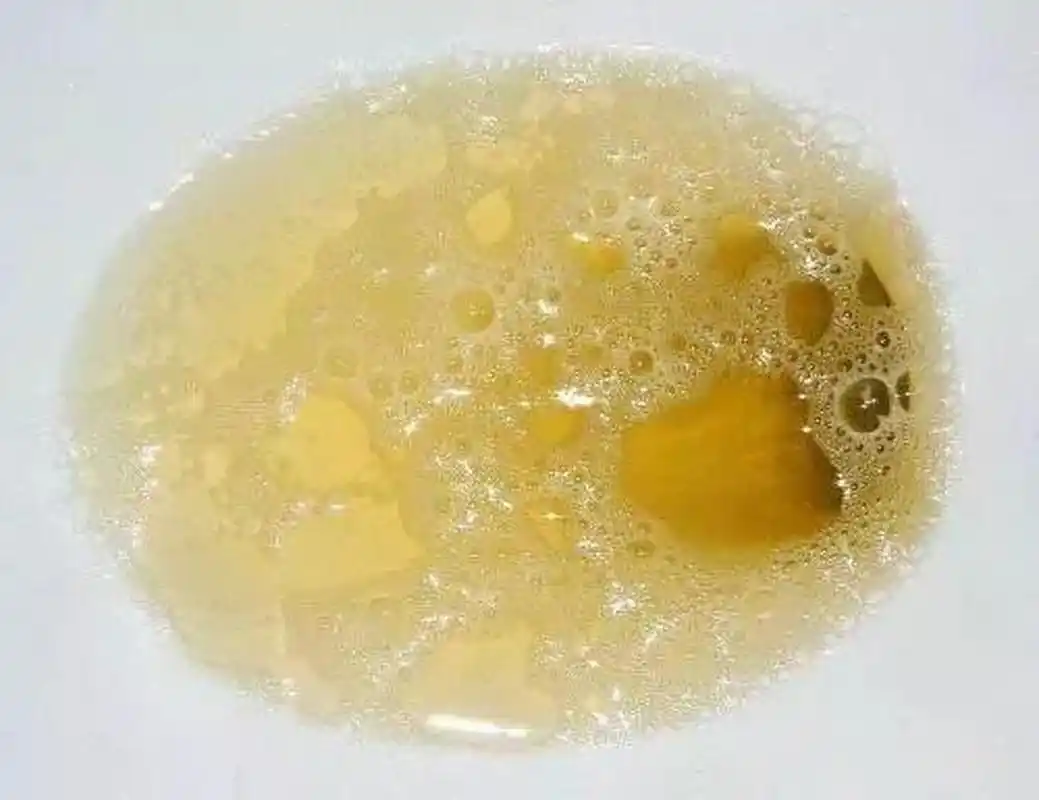 过敏性紫癜后出现血尿,就是紫癜性肾炎吗?