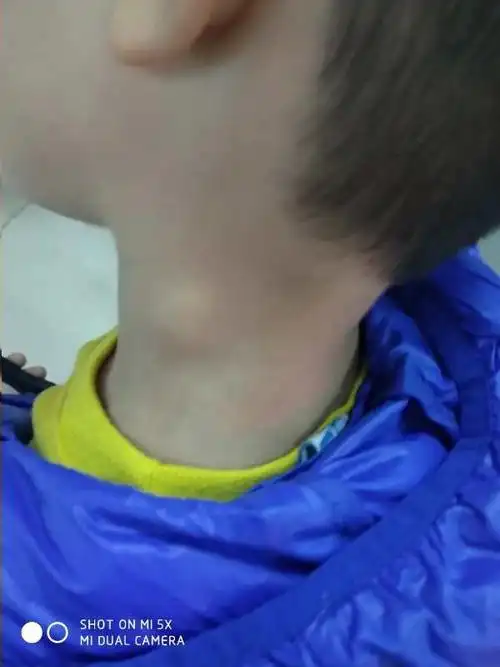 淋巴结一直都不消想问一下应该怎么办呢