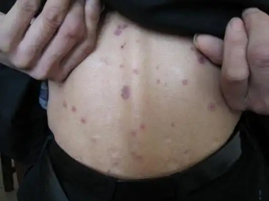 梅毒早期图片 (57)