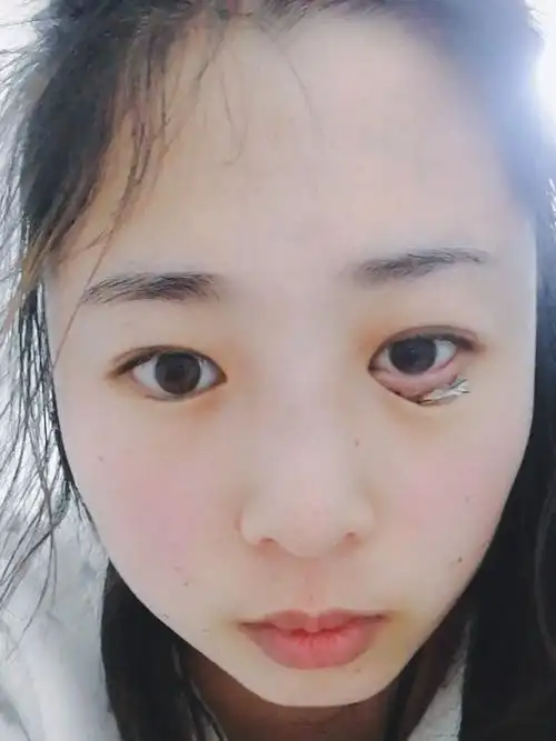 倒睫毛手术会留疤吗倒睫毛手术倒睫毛图片倒睫手术疤痕图片倒睫毛图片