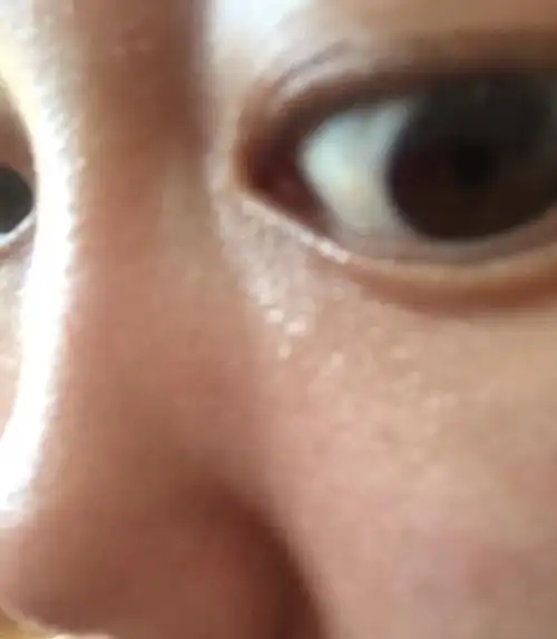 白眼球上长了一个黄色隆起,请问是什么啊?另外角膜炎刚好一个月,最