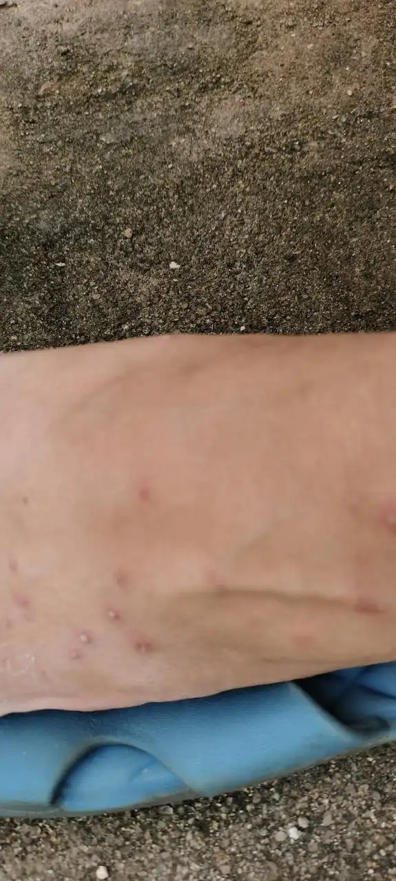 被蚂蚁咬成这样能不能成为蚂蚁侠