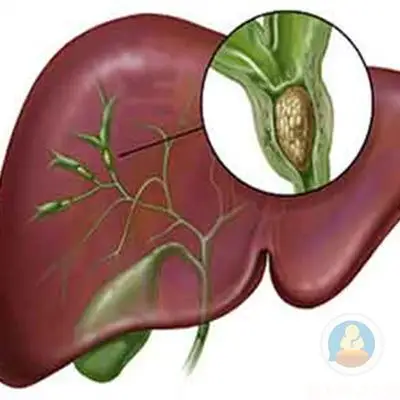 胆管癌的症状有哪些