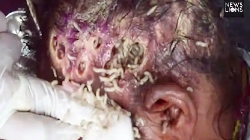 恶心 慎点:无家可归女头部被大量蛆占领