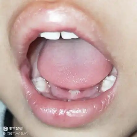 1岁半的男宝宝舌头下面长了像肉一样的东西有人知道么着急
