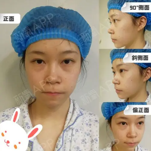 中庭低平,鼻基底凹陷95,自称"牛鼻子"的小仙女,其_圈子-新氧美容