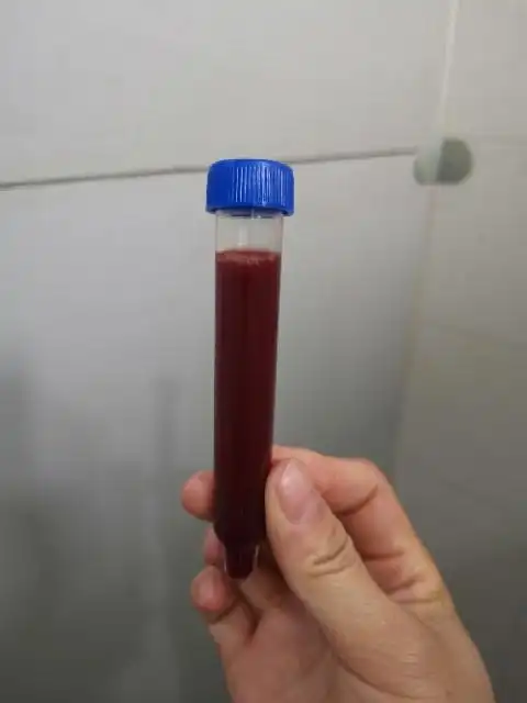 尿路感染血尿有没有类似情况姐妹有心里阴影了