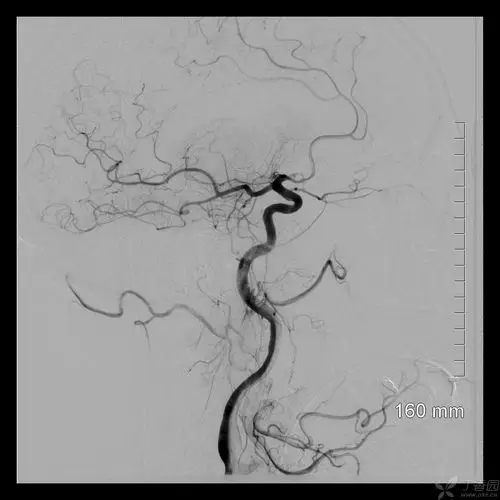 solitaire取栓后完全复通