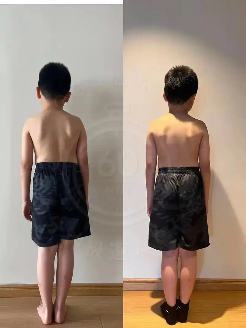 脊柱侧弯带来的影响.z yoga |青少年脊柱侧弯案例 从动 - 抖音