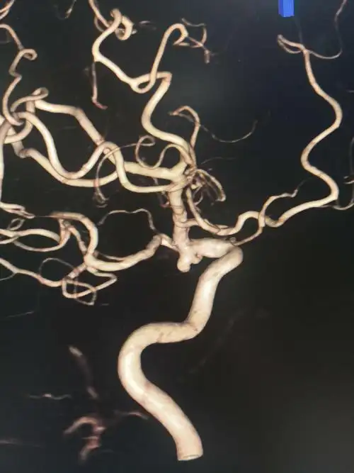 右后交通宽颈动脉瘤支架辅助栓塞