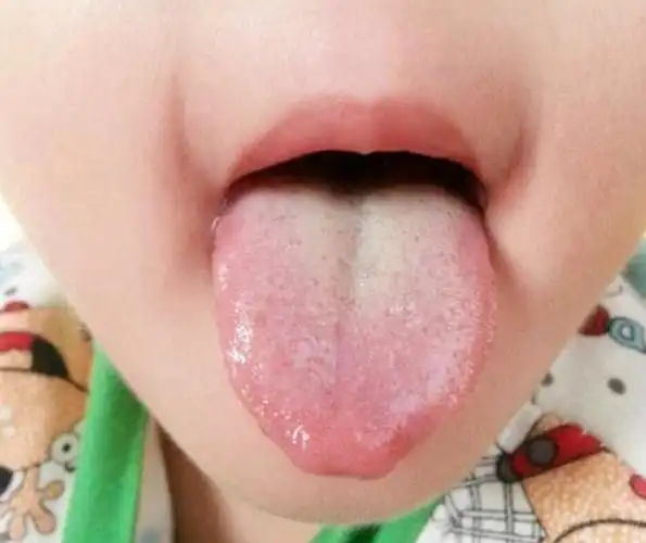 舌苔厚腻发白—宝宝积食后,还有一种常见的表现就是脸部暗黄,没有血色