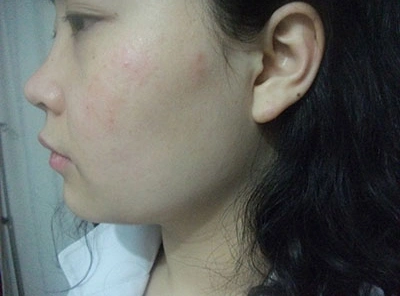 丙肝外在表现——皮肤病