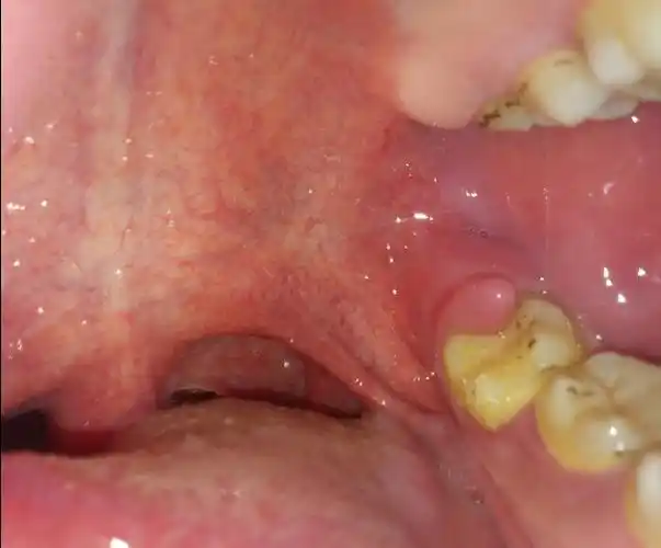 请问这是牙龈肿痛吗?长了个小疙瘩,好疼啊