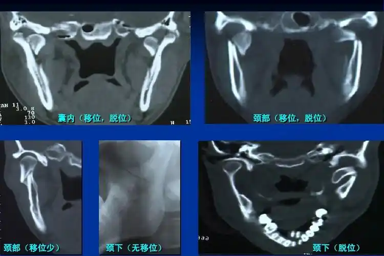 颞下颌关节脱位ppt