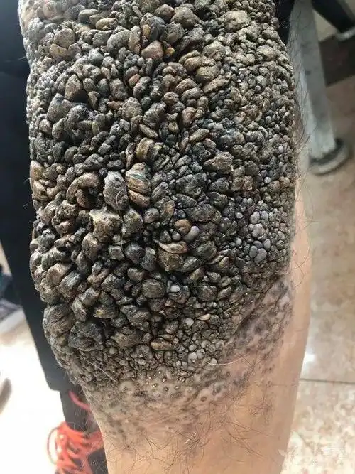 患者腿上长满石子,看得我密集恐惧症要犯了