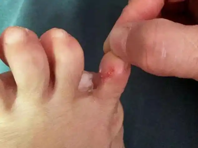 脚趾水泡瘙痒挠破?康复者分享一招,根治脚气只要50天!