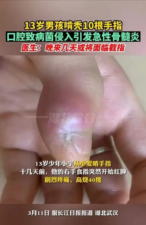 当心"祸从口出",13岁男孩啃秃十指,口腔细菌感染引发骨髓病变